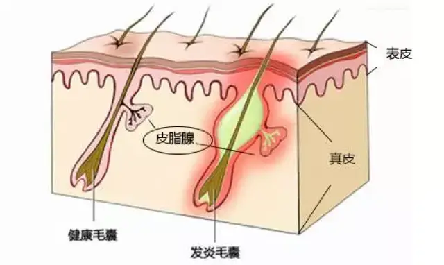 痘痘的前半生【科普篇】_手机搜狐网