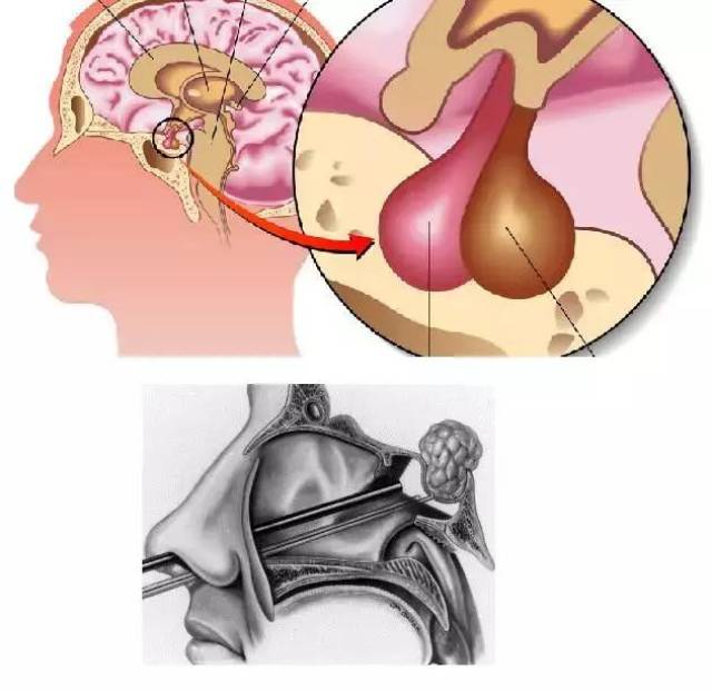 垂体瘤手术如何操作?你了解了吗?