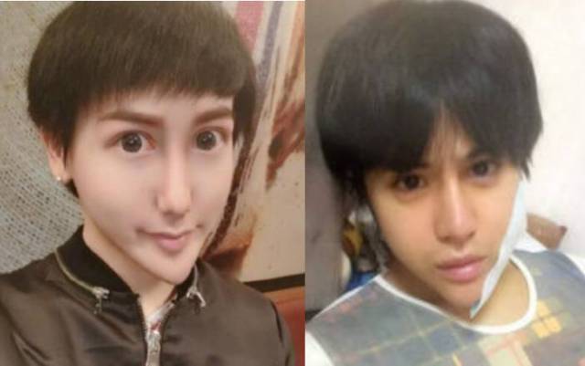 男子1年花100多万整容40次变蛇精脸,为pk刘梓晨?