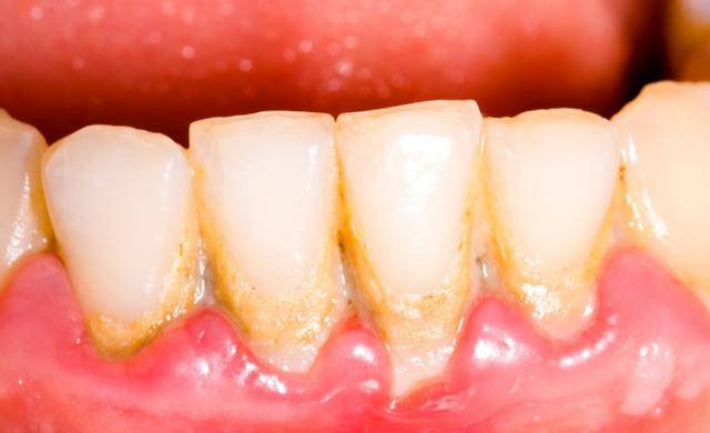 什么叫周围水肿 3f1e97af08224f69b1cba17d4655b9c6.jpeg