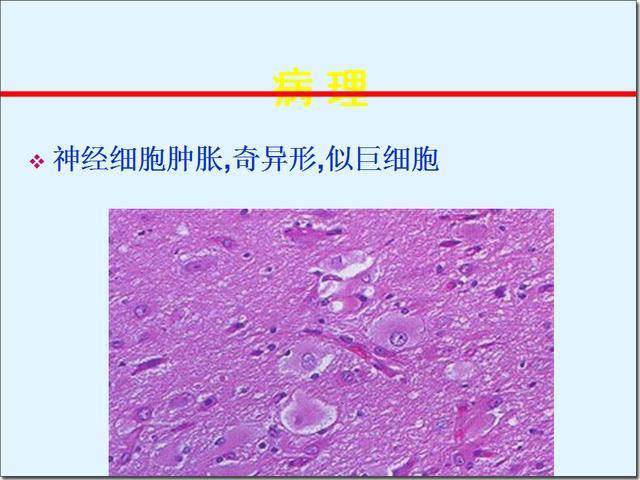 结节性硬化症