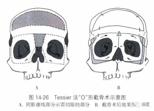 (感兴趣的可以百度一下"眶距增宽症",考虑到大家的接受度,迷死氧就不