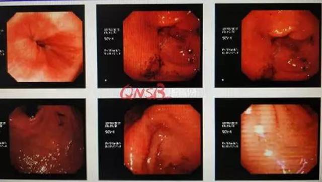小伙5年过午不食,胃里形成2个巨大溃疡!