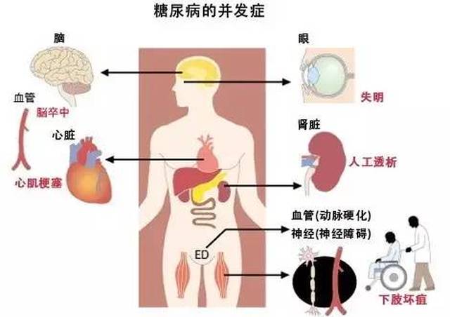 别总说血糖高没事儿 怕的是并发症