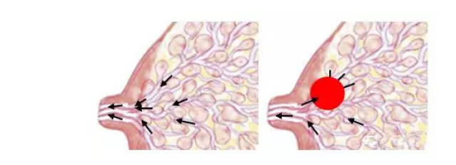 首先,我们要知道为什么会形成乳房硬块