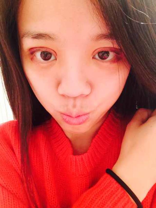 割双眼皮,那会真的特别肿,急的我像油锅上的蚂蚁