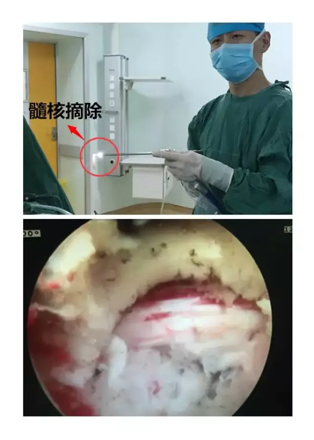 手术 腰椎间盘突出症侧路经椎间孔入路神经探查减压,髓核