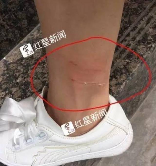 月    日,西安的 32 岁女子龙某被狗咬伤腿部.