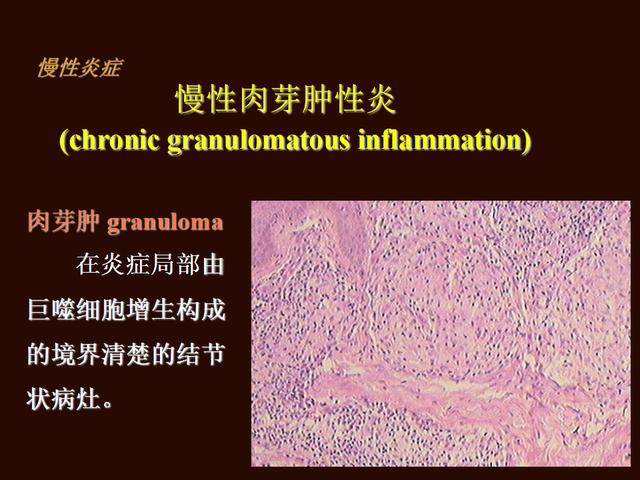 慢性肉芽组织样及炎性假瘤,息肉: 阻塞气道及肠道,息肉可有出血.