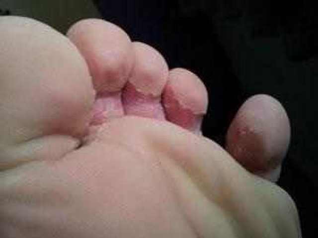 怎么解决脚趾缝里裂开痒 33cc6c071cc841ed85ad511f6a2c40d0.jpeg