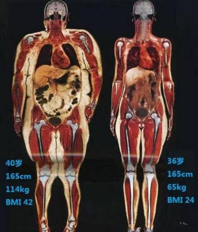 内脏脂肪的分布