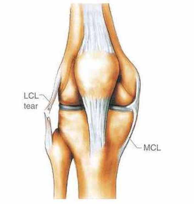 怎么判断膝盖韧带伤势的严重程度?