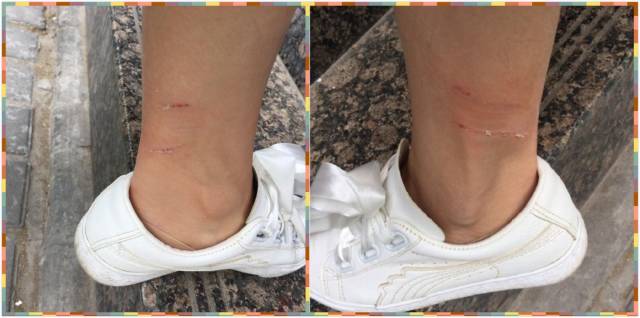 西安一女子被流浪犬咬伤脚踝,及时处置了伤口也及时接种了狂犬病疫苗