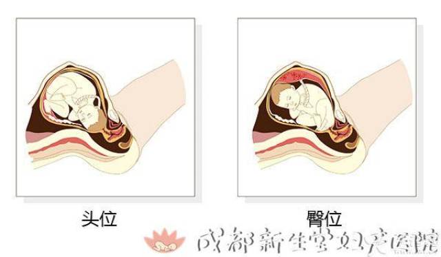 什么情况会导致宫腔分离 958062bd4548494d9aa25b97ca8394f3.jpeg