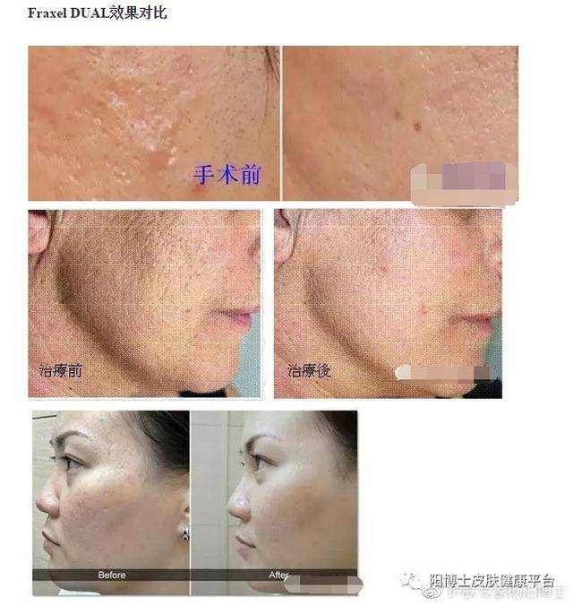 飞梭镭射美肤原理及祛痘印痘坑后注意事项