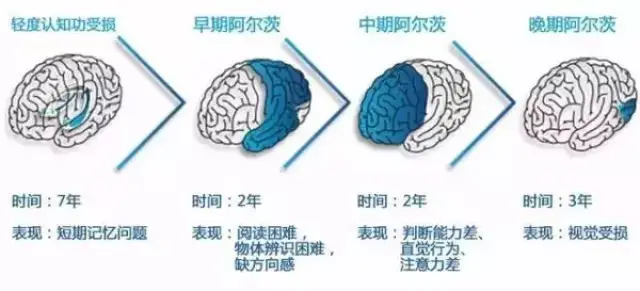 阿尔兹海默症治疗有望