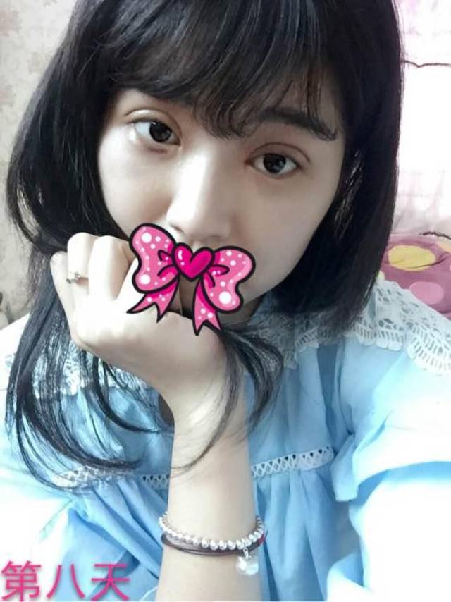 微创全切双眼皮+开眼角,第48天,侧面看起来不