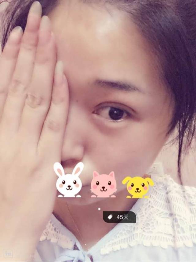 微创全切双眼皮+开眼角,第48天,侧面看起来不