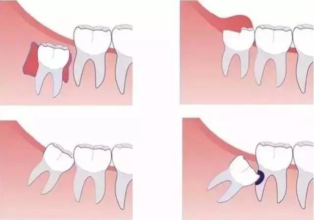 最后小编提醒大家 若是你的智齿 遇到以上情况的任何一种 别犹豫,别