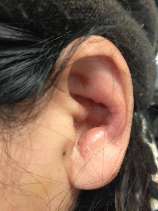 耳朵上的疱疹有可能会导致面瘫