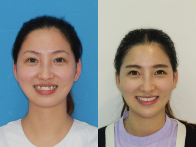 深圳拜尔齿科 牙齿矫正可以改变脸型吗?