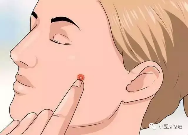 小豆芽老师教你如何正确挤痘痘!