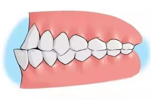 你知道什么是牙齿矫正吗?