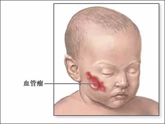 血管瘤和血管痣的区别 1,出现的时间:新生儿胎痣一般都是生下来就有