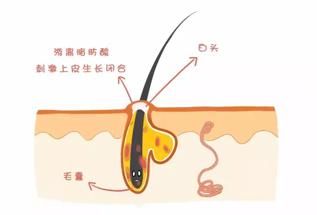 而开放性粉刺,也叫" 黑头"