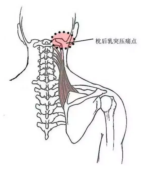 3.颈椎横突压痛点