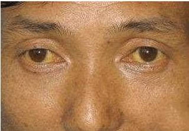 眼睛发黄多见于肝病,由于肝脏疾病造成肝脏对胆红素加工能力下降,致使