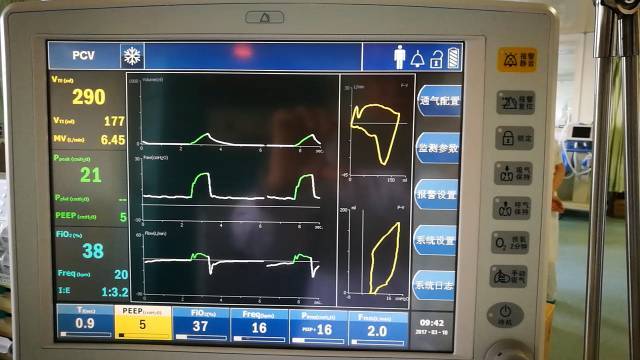 呼吸机波形指导准确调节呼吸机参数!