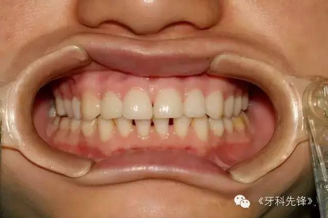 口腔病例展示:牙齿间隙过大贴面修复