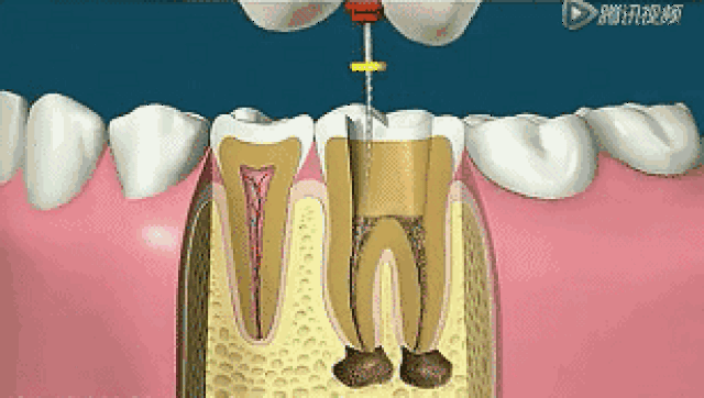 牙齿龋坏被宣判"死刑"?根管治疗可让它起死回生!