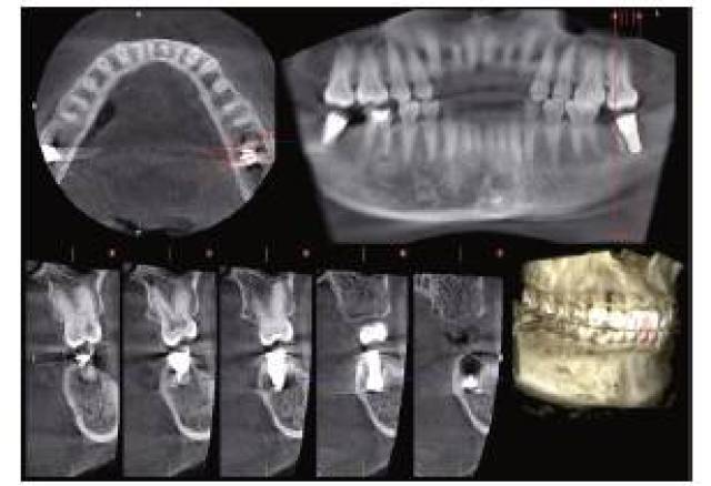 【病例分享】下颌骨岛区植入种植体的疗效探讨