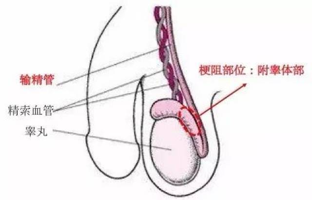 明确输精管通畅,附睾管中存在精子后,绕过附睾梗阻部位,将输精管与