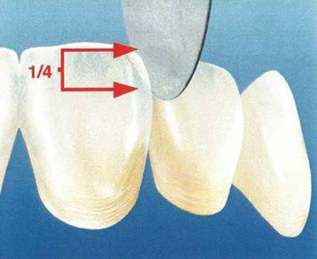 确保切片与邻接面分离区域一致,随时牢记牙齿长轴位置,可调动桥体角度