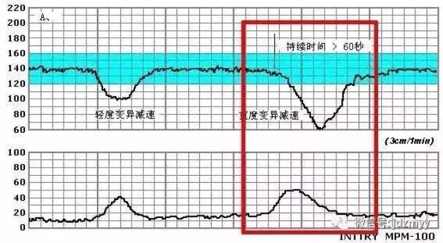 胎心监护什么样的曲线,才表示宝宝很好呢?