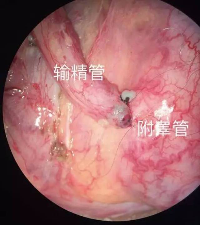 对双侧输精管及附睾进行探查,明确输精管通畅,附睾管中存在精子后