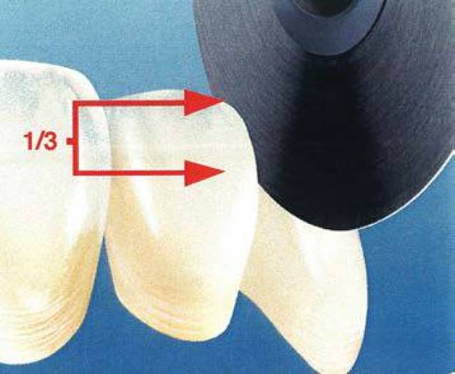 确保切片与邻接面分离区域一致,随时牢记牙齿长轴位置,可调动桥体角度