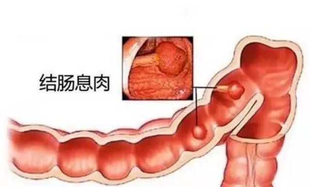 03 通常会在便后发现有血液染于大便之外,不与大便混合,直肠息肉还