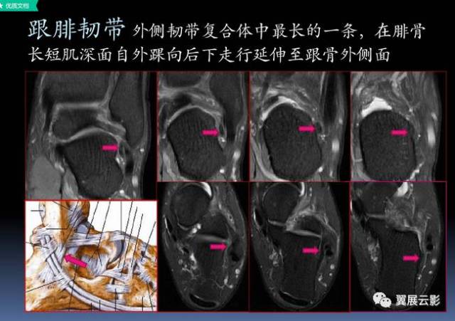 踝关节mri解剖及常见病变