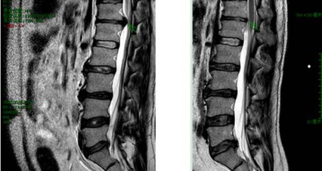 高位腰椎间盘突出真实案例,给您扒一扒不同手术的利与