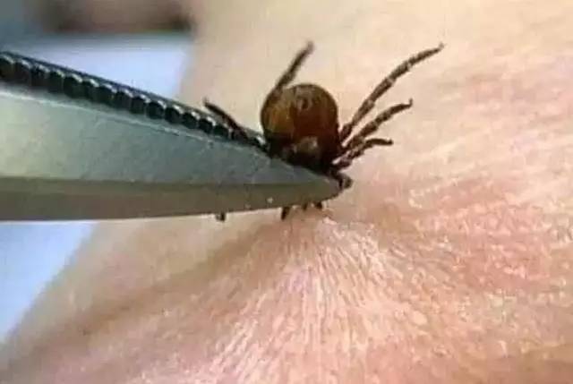 蜱虫尽管小但是损害的确很大, 许多人发现皮肤里边有蜱虫后,在什么也