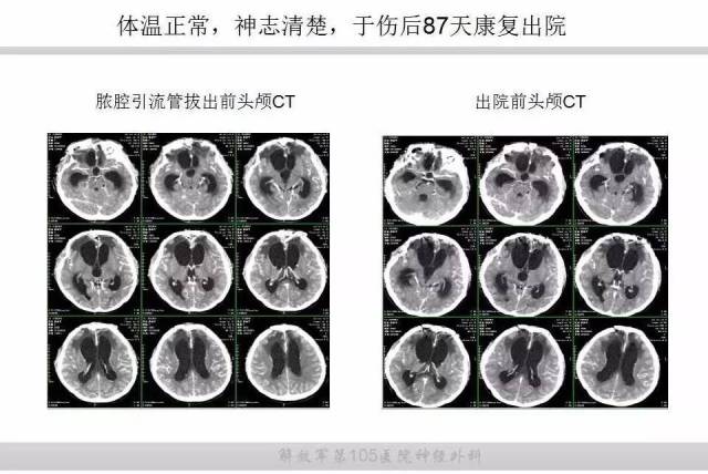 重型开放性颅脑损伤致脑脓肿一例丨颅脑创伤-神经重症