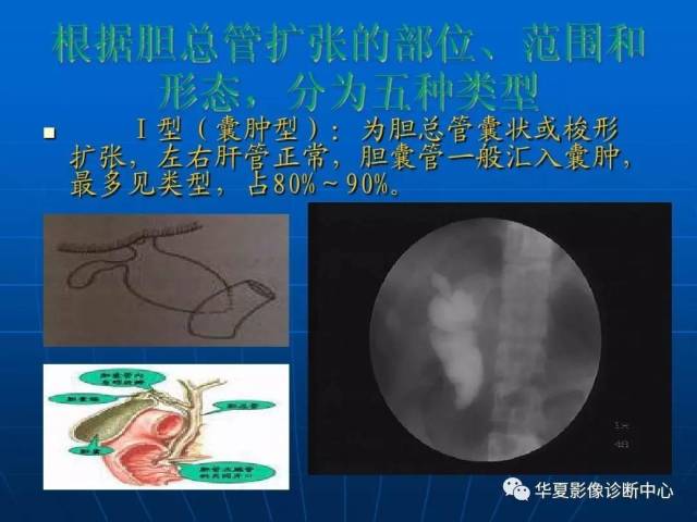 先天性胆管囊肿,该怎么分型?