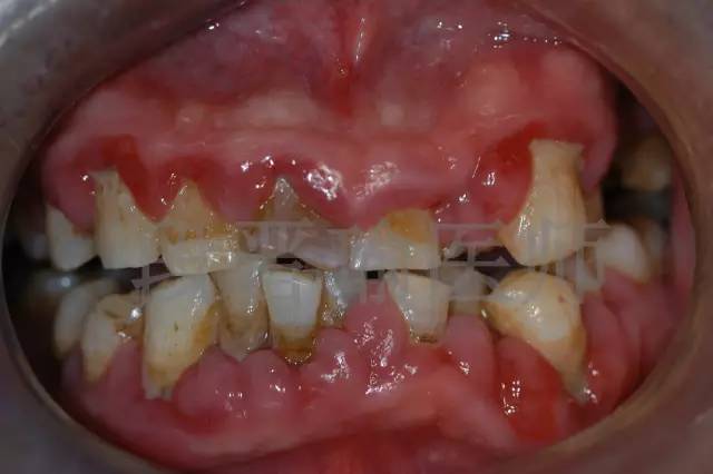 牙周刮治后牙龈明显恢复,增生消除