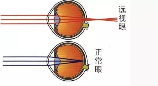 ③高度远视:> 5.