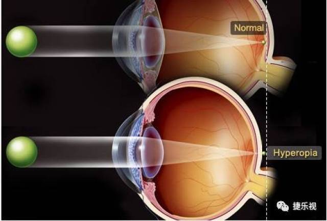 【视光知识】这些眼睛病变的征兆,你都知道吗?别等失明了才后悔