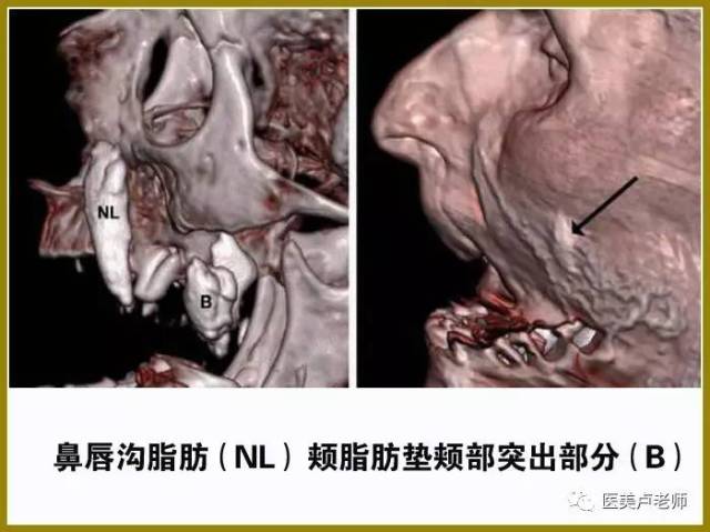 三维重建(左:骨窗,右:软组织窗)显示鼻唇沟脂肪(nl)和颊脂肪垫颊